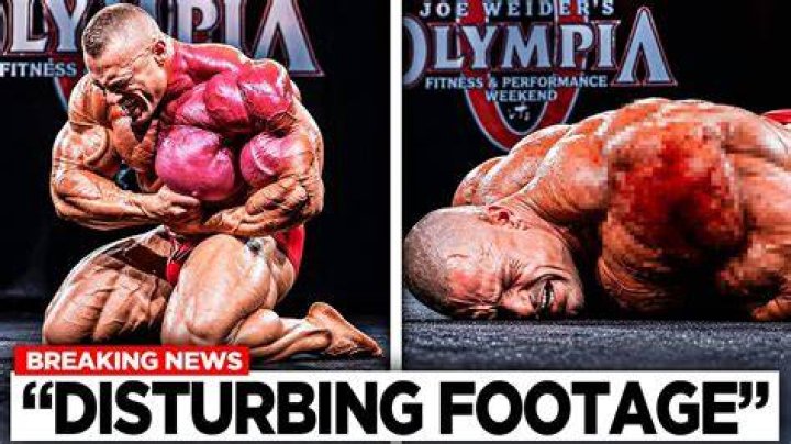 Bodybuilders whose muscles torn from bone develop cysts after worst pain