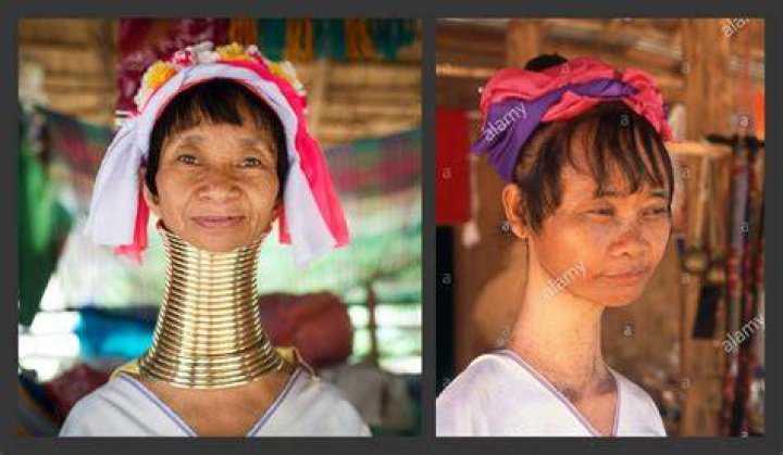 Woman With Neck Rings Removed